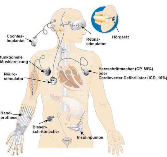 Person mit schematisch dargestellten Implantaten