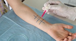 Foto: bei einem medizinischen Allergie-Test werden auf einen Arm verschiedene Substanzen aufgetragen