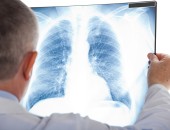 Beruflicher Umgang mit den Metallen Chrom und Nickel kann Lungenkrebs-Risiko erhöhen 