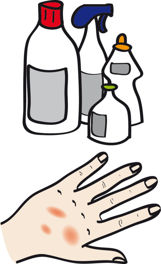 eine Hand mit Hautverletzungen und Reinigungsmittel